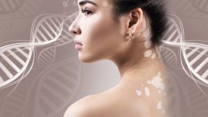 健康養生:談白斑症　從生活中照顧皮膚