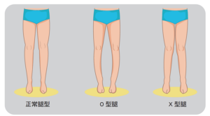 足弓型態會影響腿型