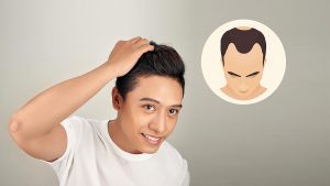 健康養生:如何治療圓禿？