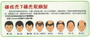 臨性禿7稹禿髮類型