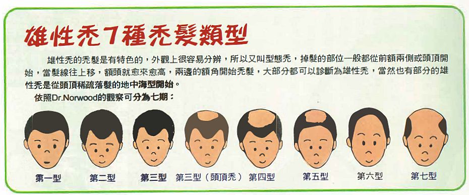臨性禿7稹禿髮類型