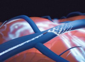 Synchron透過血管介入技術植入腦機介面